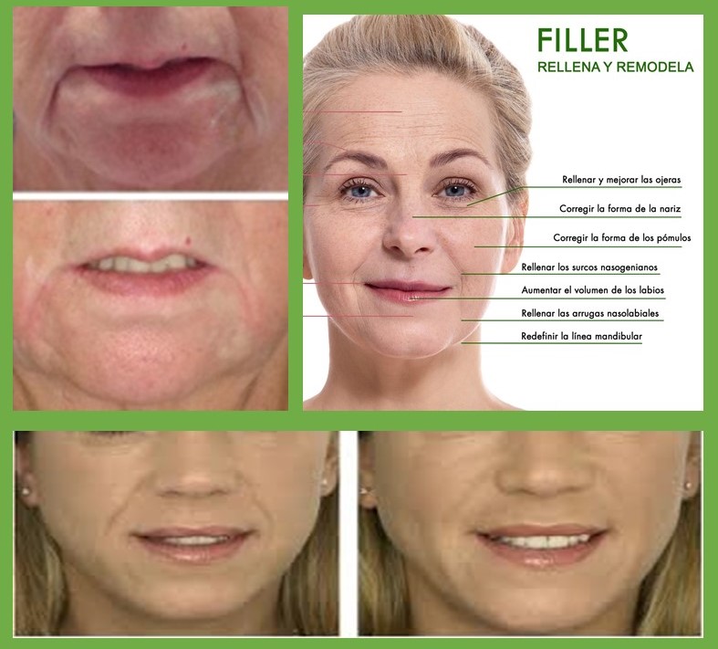 Dermal Fillers: Types, Indications, and Complications Materials de relleno: typos, indicaciones y complicaciones