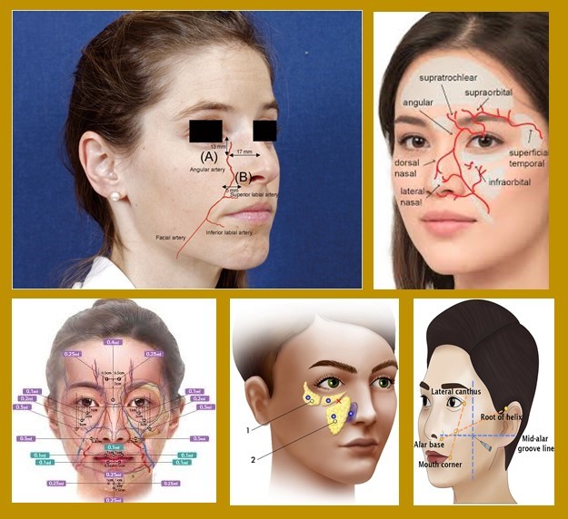 Facial fillers: Relevant anatomy, injection techniques, and complications
